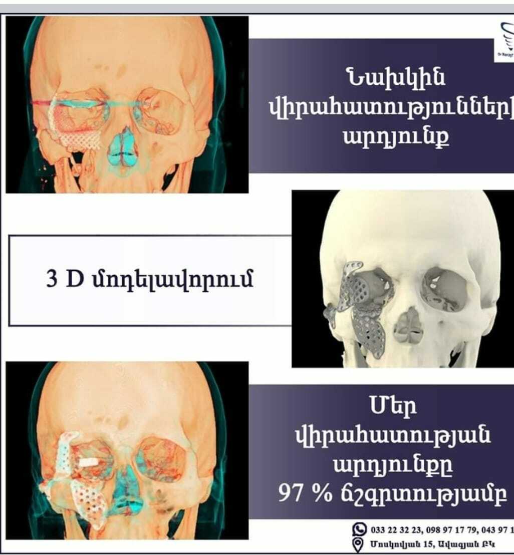 КТ до операции — дефект орбиты